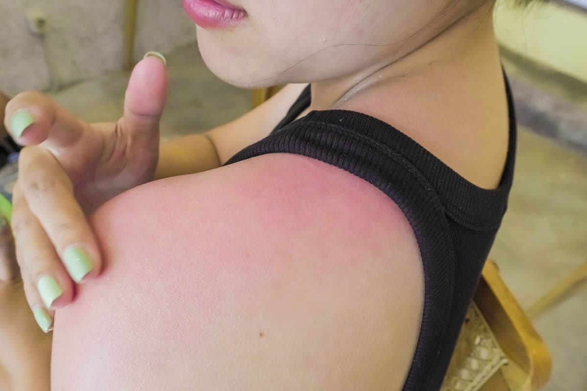 Sunburnt shoulder of a woman after going to the beach